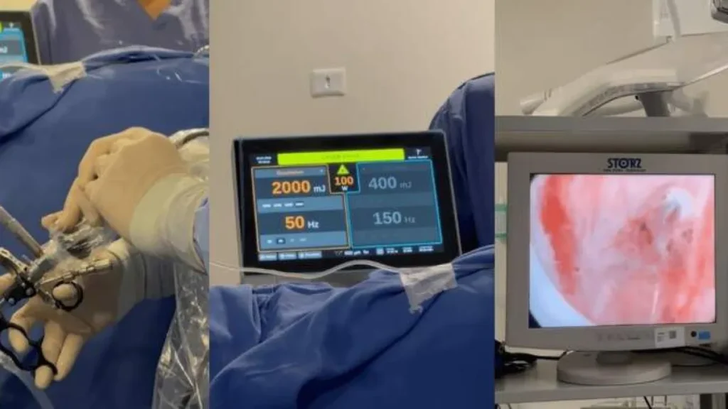 HU realiza primeiras cirurgias de próstata a laser no SUS