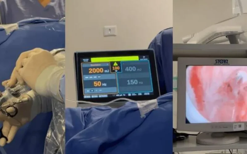 HU realiza primeiras cirurgias de próstata a laser no SUS