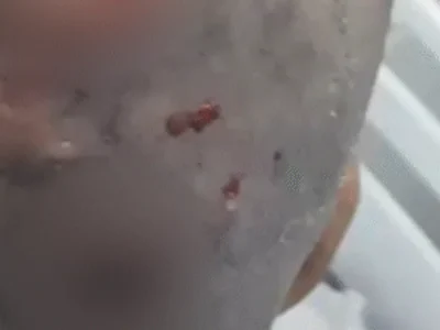 Mulher com larvas na cabeça é resgatada e polícia apura estupro